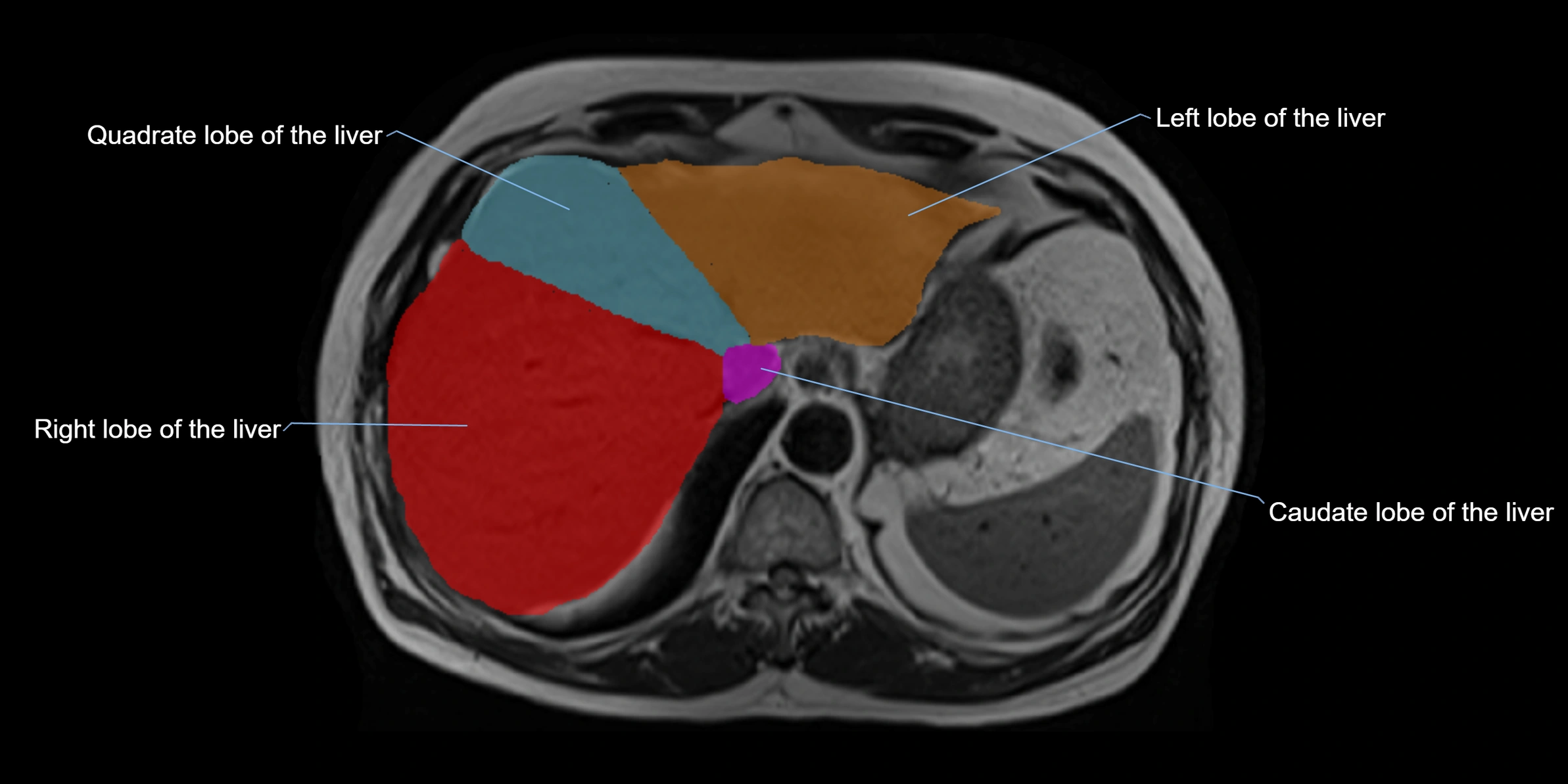 MRI liver lobe axial cross sectional 3T radiology  image-img-00001-00008.webp